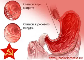 Слизистая желудка при гастрите